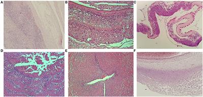 Placental Pathology Findings and the Risk of Intraventricular and Cerebellar Hemorrhage in Preterm Neonates